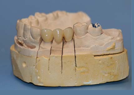 Zircon porcelain bridge on a model