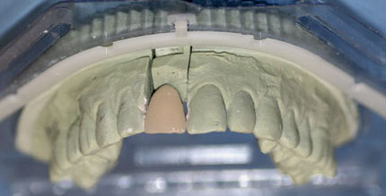 A metal ceramic crown