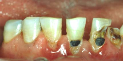 root-canal.jpg