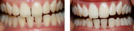 tooth bleaching
