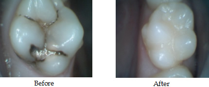 composite filling