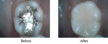 white fillings