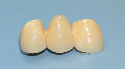 A zirconia ceramic bridge